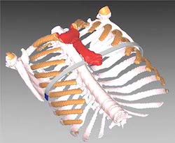 Pectus Bar 3D Scan